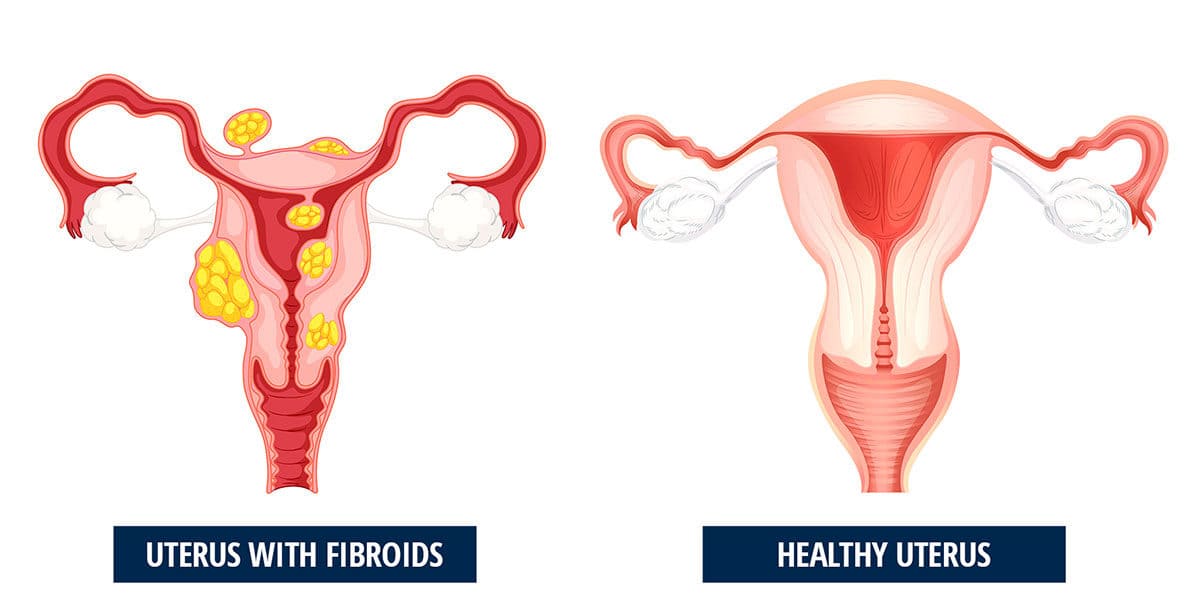 Best Treatment For Uterine Fibroids Unique Interventional