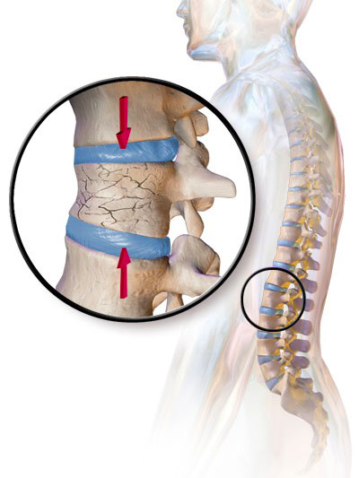 Fracturas de la Compresión Vertebral - Unique Interventional