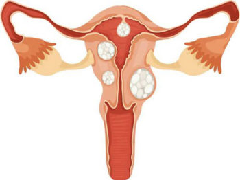 Fibroid-Symptoms-2-miami-Unique-Interventional-Radiology