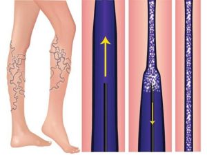 Spider Vein Treatment Miami - Unique Interventional Radiology - Sclerotherapy