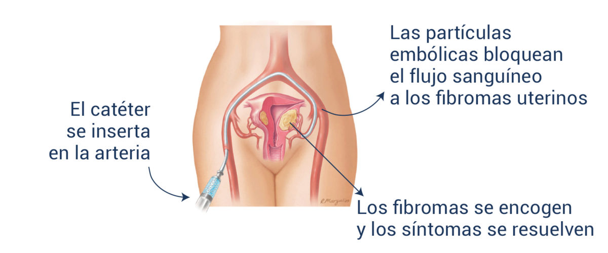 pompano-miami-dr-hughes-unique-interventional-radiology-doctors-testimonio-fibromas-uterinos-