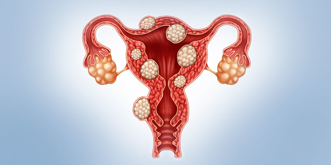 Treatments For Ufe And Uterine Fibroids Unique Interventional