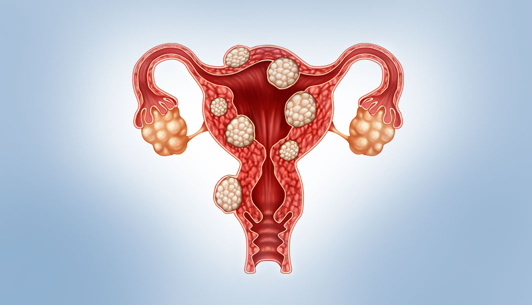 How to treat Uterine Fibroids, Treatments and UFE explained Unique