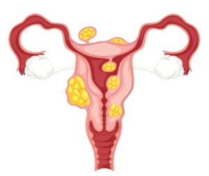 The-fibroid-that-grows-is-cancer